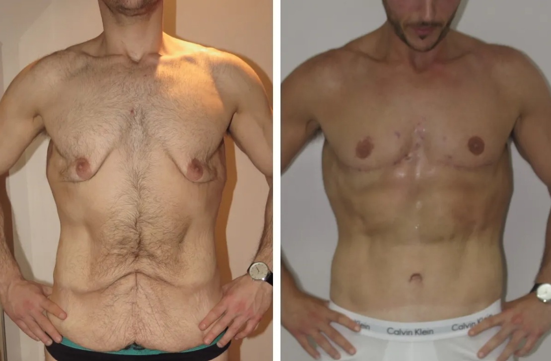 Gastric Bypass (Weight Loss Surgery) - Wadi El Neel