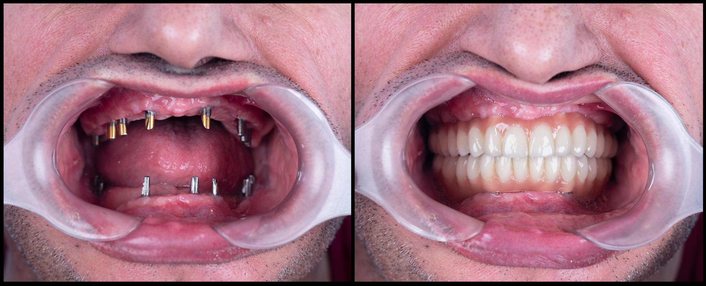 Dental Implant - Wadi Al Neel